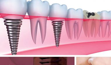TRỒNG RĂNG IMPLANT