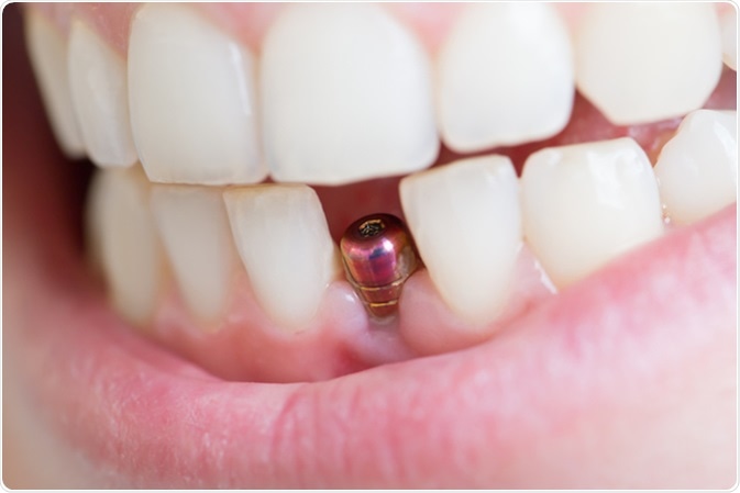 CẤY GHÉP IMPLANT