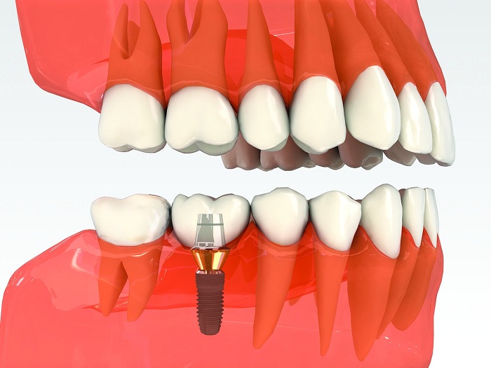 TRỒNG RĂNG IMPLANT